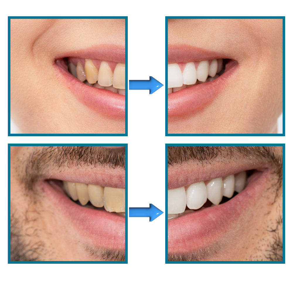 Dentifrice blanchisseur de dents et élimination rapide des taches
- Ozerty