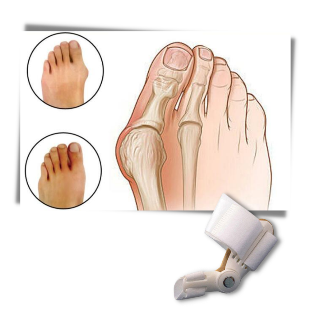 Correcteur d'oignon au pied orthopédique - Ozerty
