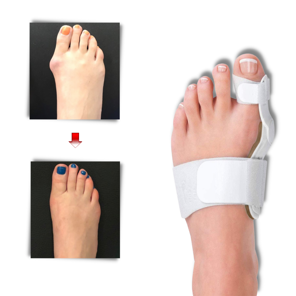 Correcteur d'oignon au pied orthopédique  - Ozerty